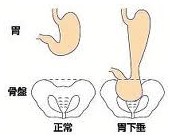 該如何預(yù)防胃下垂